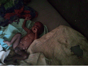 People are dying of famine in Ethiopia, Hararghe including children, mothers and adults July, August 2015 during Obama Africa visit1