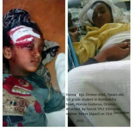 Hanna doja. Oromo child, 1st grade student in Kombolcha, Horroo Guduruu, Oromia. Attacked  by Ethiopian regime fascist  forces on 31st December  2015