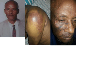 Kebede Gemeda, 70 years old Oromo man. He was arrested at the Grand Rally in Finfinne. He was beaten so badly that he lost one of his eye sight completely.